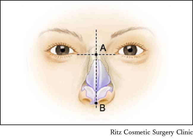 鼻根部が偏位している場合、中央線に沿って左右の剥離を均等に行う