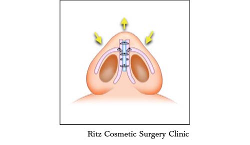 鼻尖縮小・形成術（団子鼻整形）　鼻の下から見たイメージ