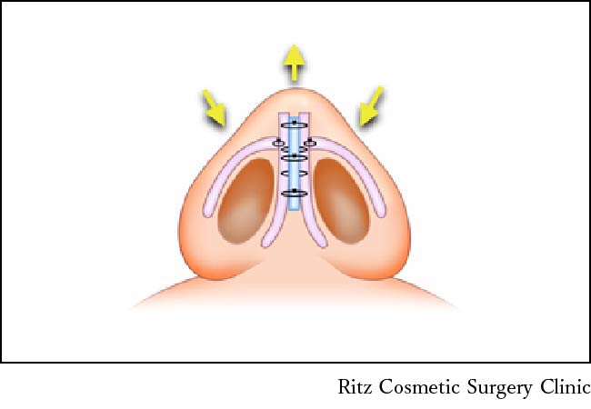 鼻尖縮小・形成術（団子鼻整形）　鼻の下から見たイメージ