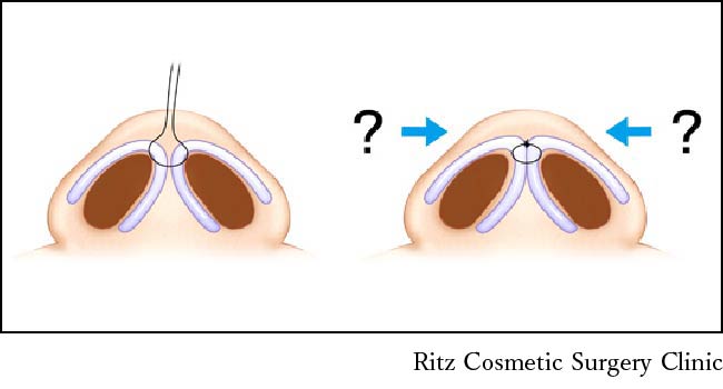 鼻尖（鼻先）の両端での高低差を出すイメージ