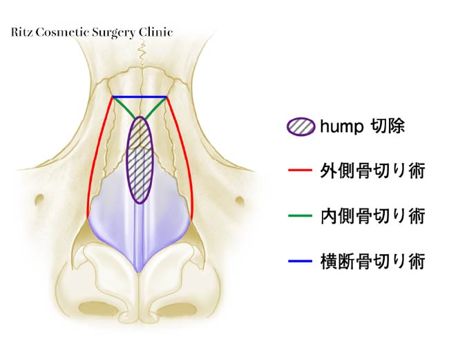 鼻骨骨切り術の３つの骨切りラインの分類　Ⅰ．外側骨切り(lateral osteotomy)　Ⅱ．内側骨切り(medial osteotomy)　Ⅲ．横断骨切り(transverse osteotomy)