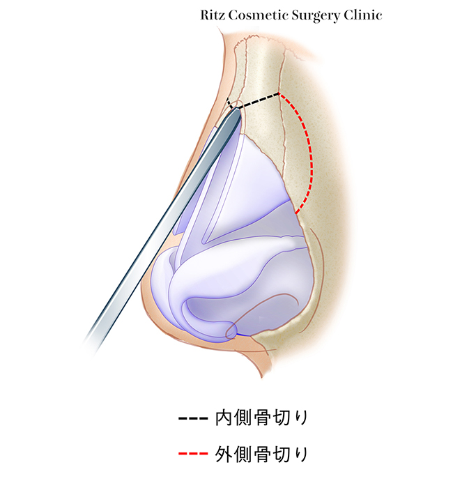 内側骨切り術(medial osteotomy)