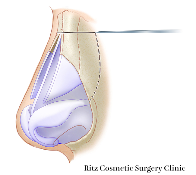 横断骨切り(transverse osteotomy)