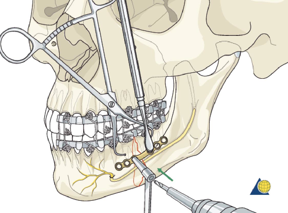 プレートシステム(骨固定用)の手術時のイメージ図