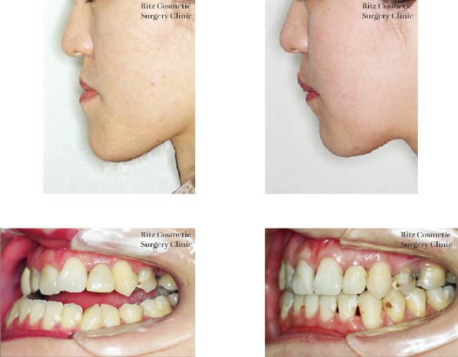 症例：骨格性下顎前突症：下顎枝矢状分割法（SSRO）