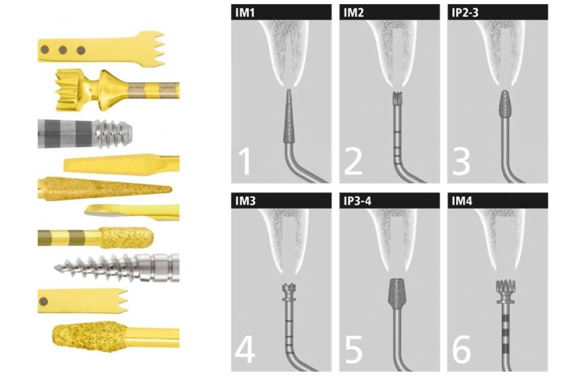 超音波骨切器～ピエゾサージェリーの機器の種類および６つの骨切りイメージ