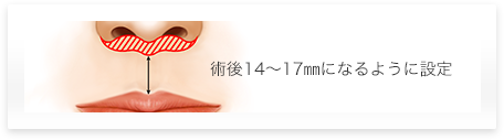 術後14〜17mmになるように設定